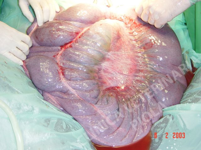 Torsione del colon ascendente